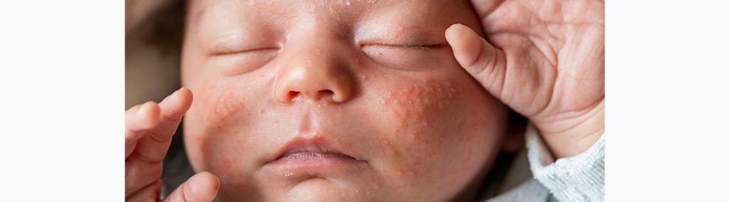 O que é acne neonatal?