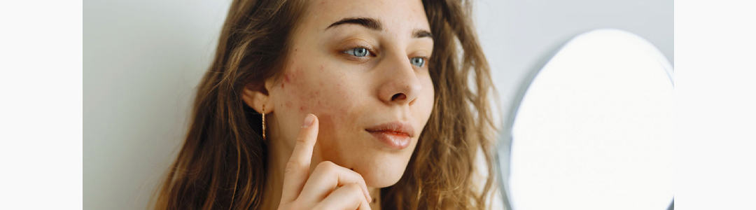 Quais são os principais tipos de acne?