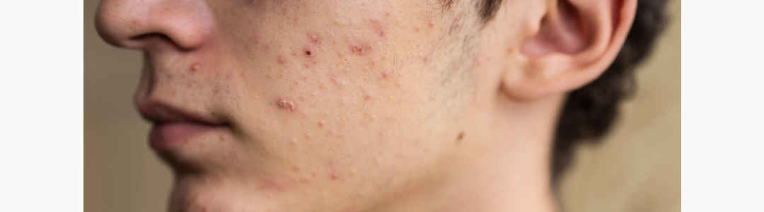 O que é acne?