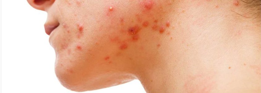 O que causa muitas espinhas no rosto - acne hormonal