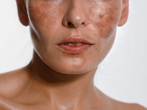 Melasma no rosto: guia definitivo de como cuidar das manchas!