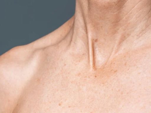 Quais são os tipos de câncer de pele