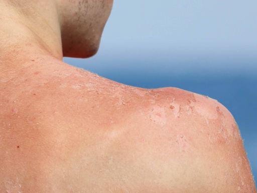 Ações imediatas - o que fazer ao perceber que exagerou no sol Ações imediatas - o que fazer ao perceber que exagerou no sol