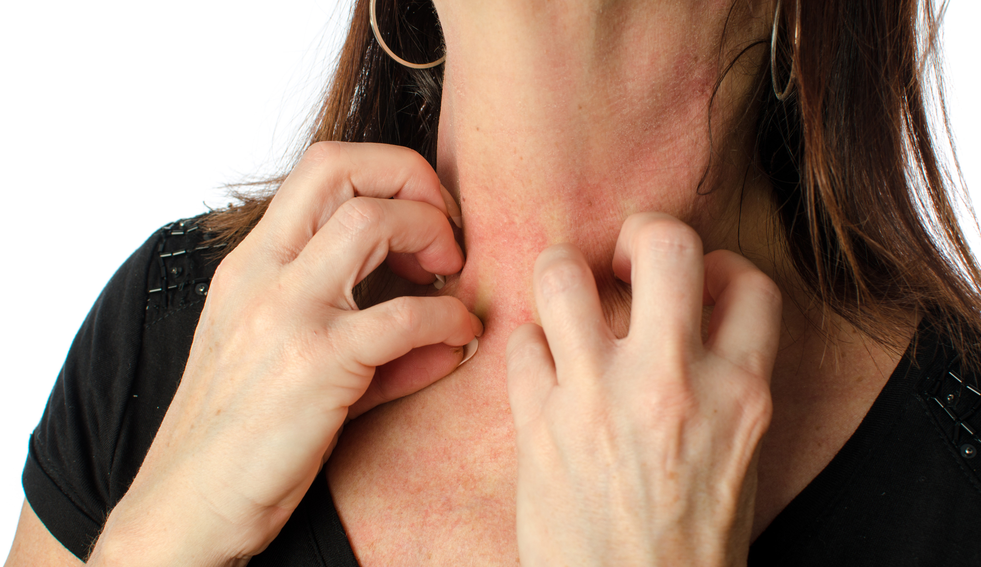 Dermatite atópica: como ela pode impactar a qualidade de vida?